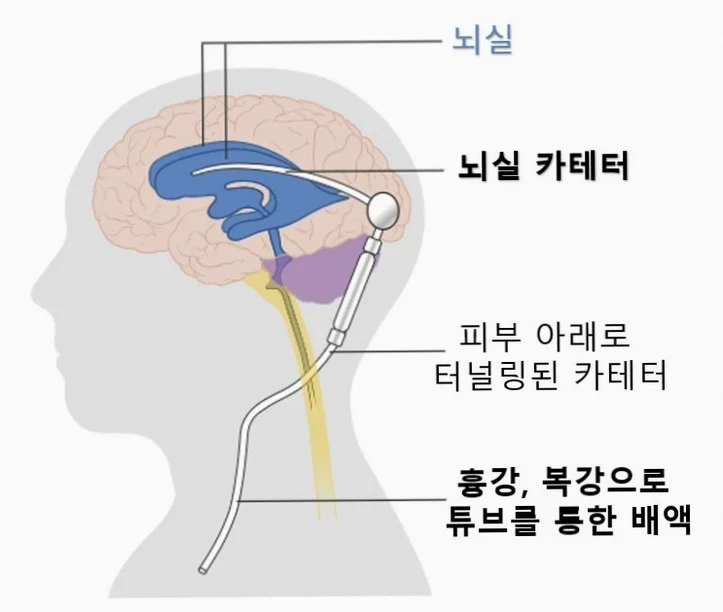 사람의 옆모습 두뇌에 뇌실 카테터가 삽입되어 뇌실에서 뇌척수액을 배액하는 션트 수술 과정을 보여줍니다. 피부 아래로 터널링된 카테터가 흉강이나 복강으로 이어지는 수두증 증상 완화 목적의 시술입니다.
